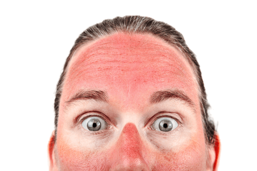 Eye Sunburn – Causes, Treatments, Symptoms